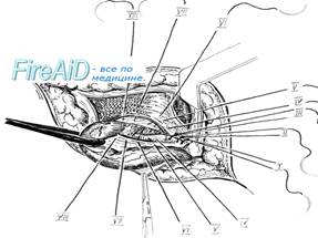     McVay ( Cooper ligament repair ).